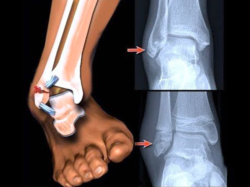 ortopedista-pe-tornozelo-fratura-pe-tornozelo-1